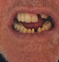 Affordable Dentist Te Atatu