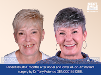 Next Smile Australia – All-on-4® Dental Implants Sydney