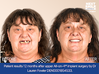Next Smile Australia – All-on-4® Dental Implants Sydney