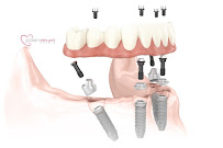 Sydney Implant Studio