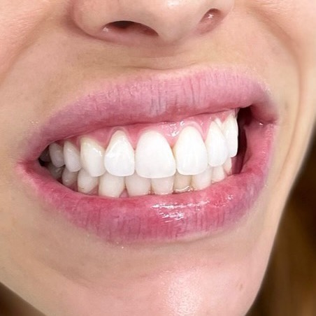 Sydney Teeth Whitening