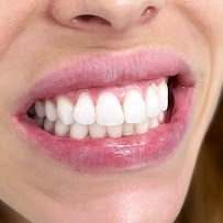 Sydney Teeth Whitening in Sydney