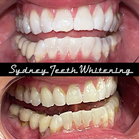 Sydney Teeth Whitening