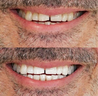 Teeth Whitening Melbourne