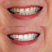 Teeth Whitening Melbourne