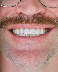 Sonreir Teeth Whitening