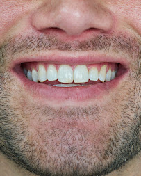 Sonreir Teeth Whitening