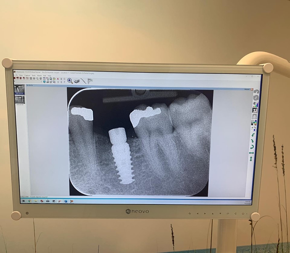 Instant Cosmetic & Implant Dental Surgery