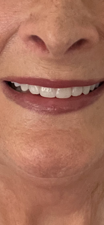 Glenferrie Dental Hawthorn - Dental Implants and All on 4 Cosmetic Dentist