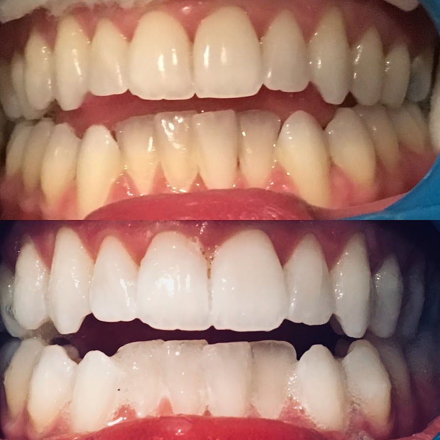 Bondi Bright Teeth Whitening