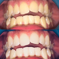 Bondi Bright Teeth Whitening