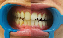 Bondi Bright Teeth Whitening