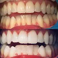 Bondi Bright Teeth Whitening in Sydney